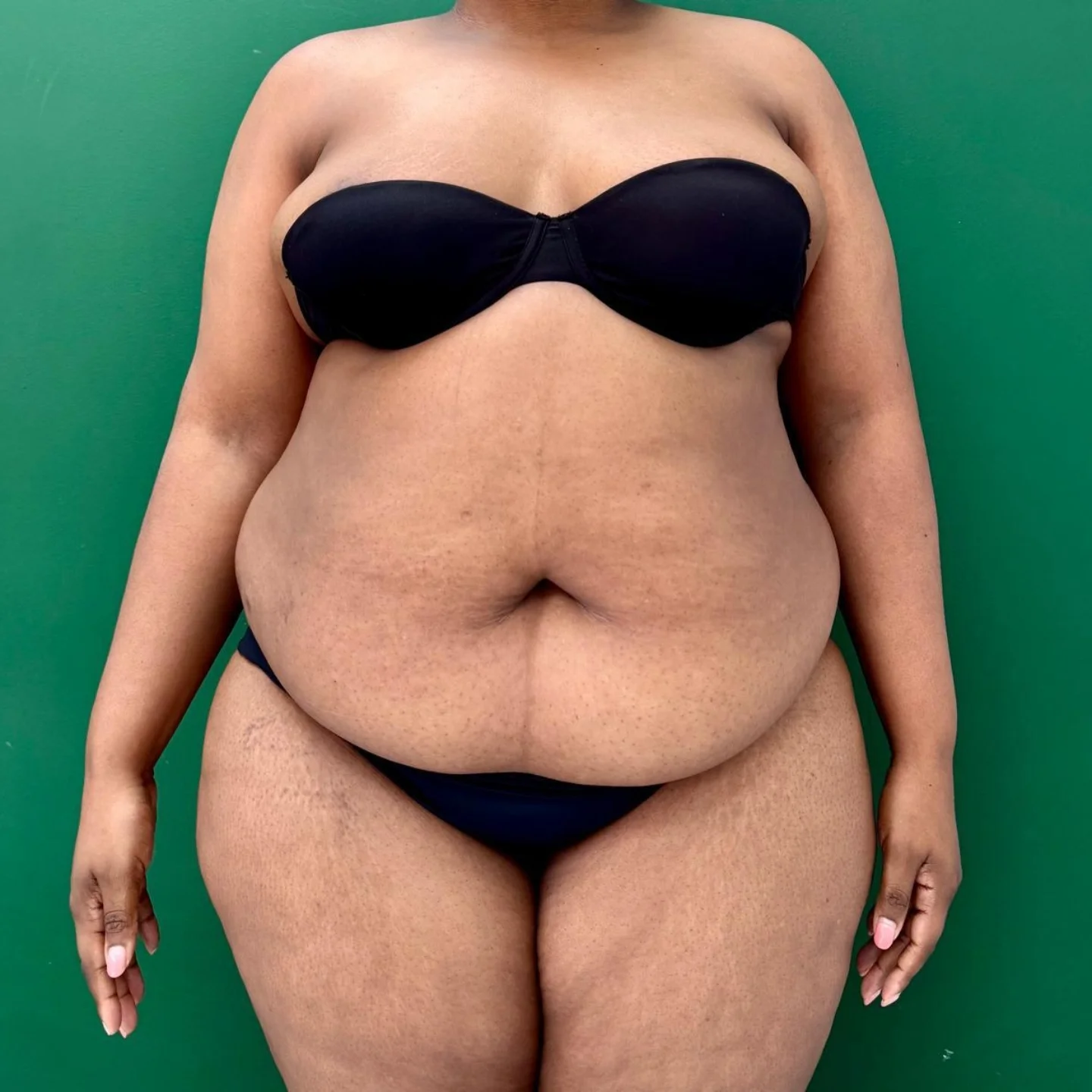 Extended Abdominoplasty Before